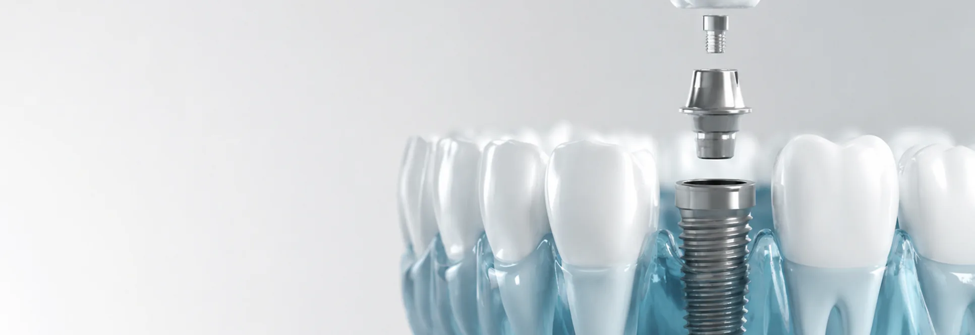 Computer guided dental implants at PermaSmile!