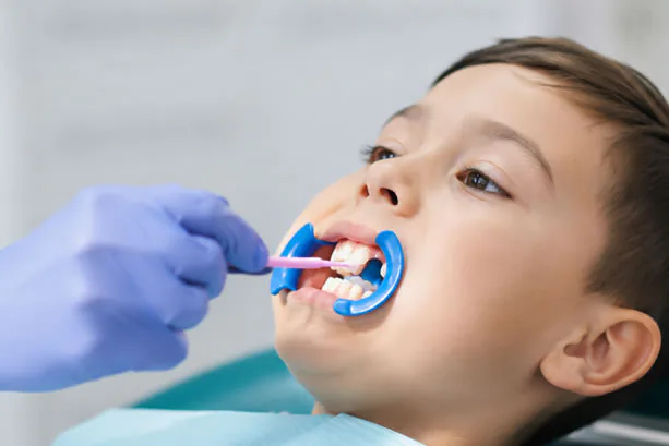 Dental sealants applied to teeth at PermaSmile!
