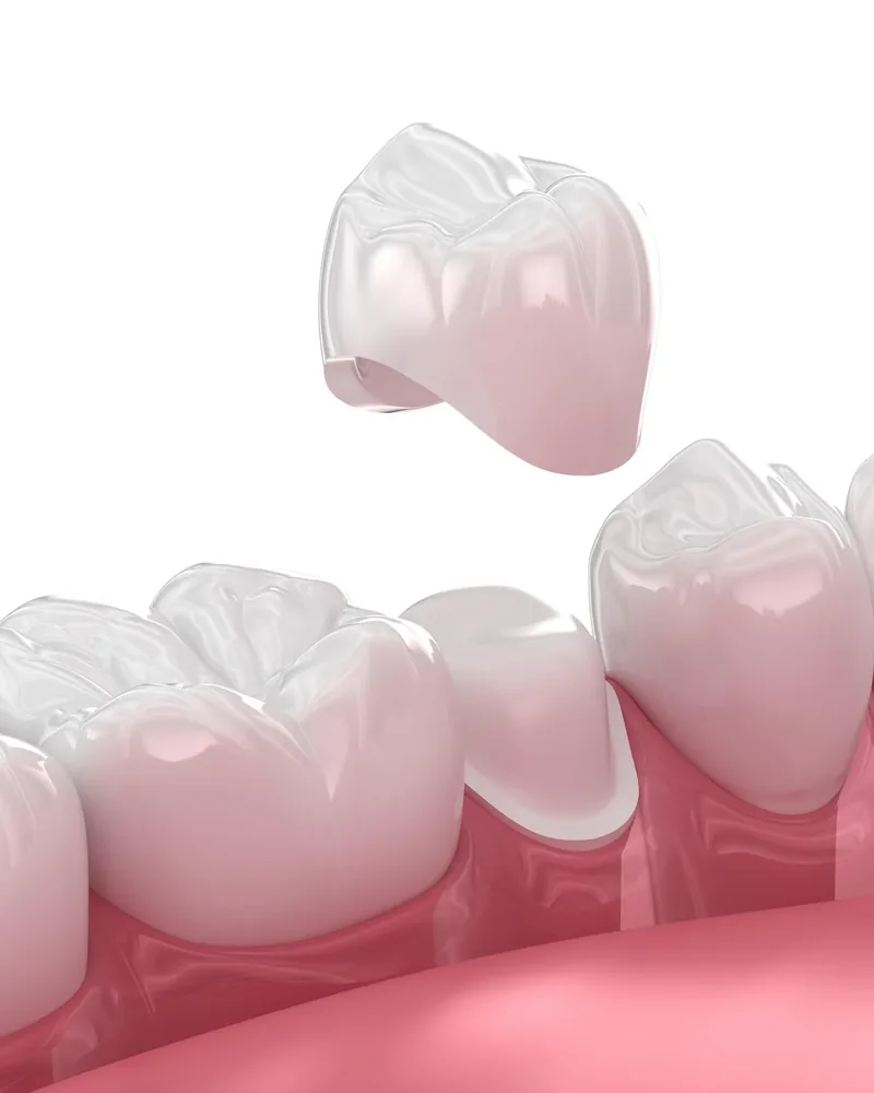 A porcelain crown being seated onto a prepared back tooth