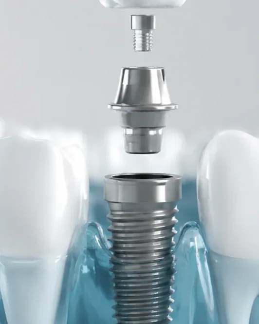 A titanium dental implant post, abutment and crown shown set into the jaw between natural teeth