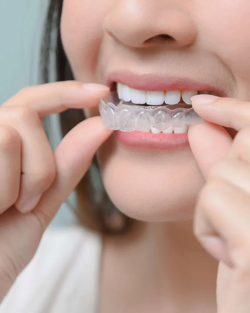 A patient placing a clear Invisalign aligner over her upper teeth