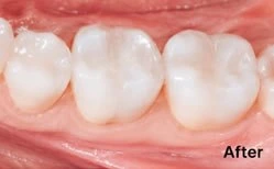 After: tooth-coloured CEREC restorations placed in a single visit