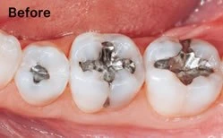 Before: old silver amalgam fillings