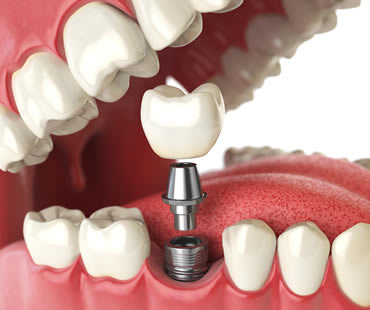 Complete Your Smile with Dental Implants