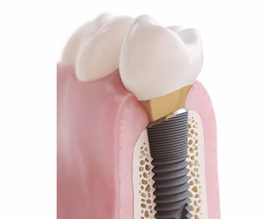 Choosing a Professional for Your Dental Implants in Ottawa