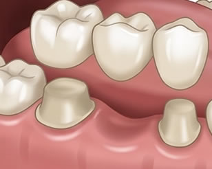 Dental Crowns and Bridges