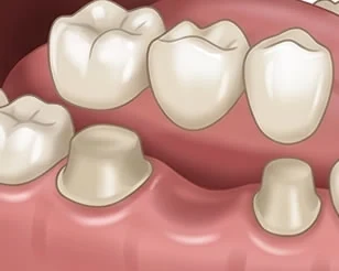 Dental Crowns and Bridges at PermaSmile! in Ottawa