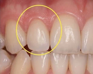Gum Disease Treatment at PermaSmile! in Ottawa