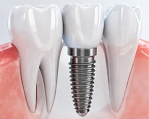 Implant Dentistry at PermaSmile! in Ottawa