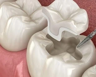 Porcelain And Composite Inlays at PermaSmile! in Ottawa