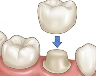 Porcelain Crowns at PermaSmile! in Ottawa