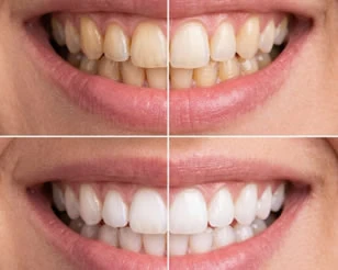 Teeth Whitening at PermaSmile! in Ottawa