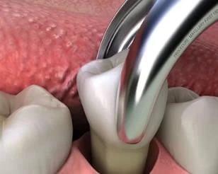 Tooth Extractions at PermaSmile! in Ottawa