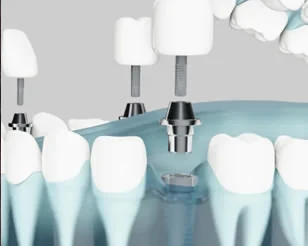 Computer Guided Dental Implants at PermaSmile! in Ottawa