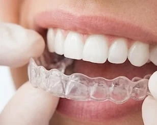 Invisalign at PermaSmile! in Ottawa