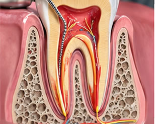 Root Canal Therapy
