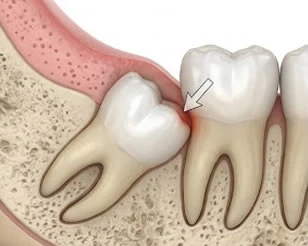 Wisdom Teeth Removal at PermaSmile! in Ottawa