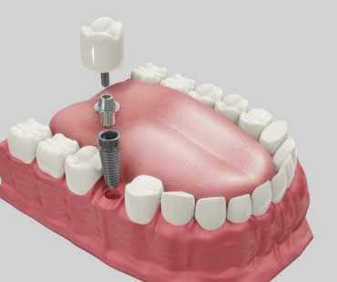 The Many Benefits of Dental Implants